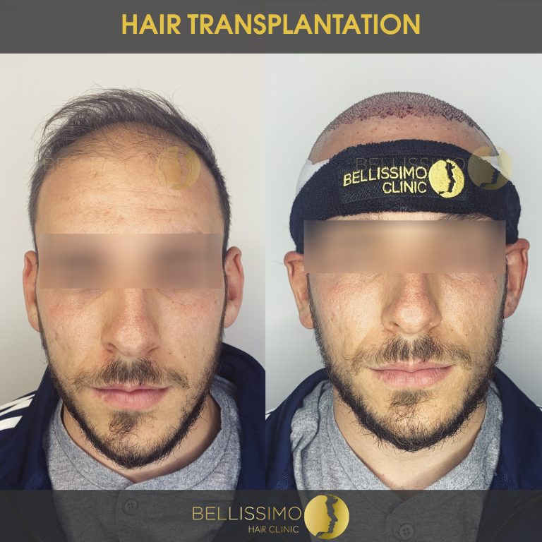 Трансплантация на коса, пациент, Bellissimo clinic