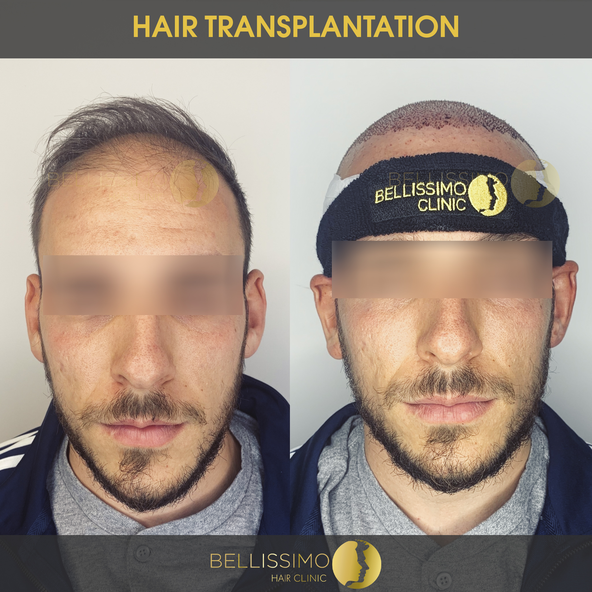 Hair transplantation - Bellissimo clinic