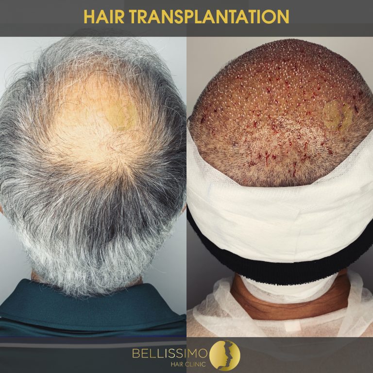 Трансплантация на коса, пациент, Bellissimo clinic