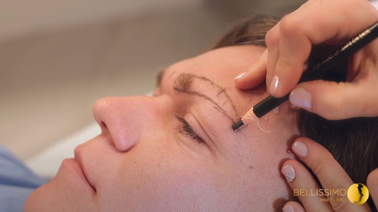 Read more about the article Eyebrow transplantation