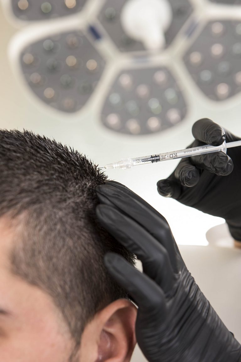 Read more about the article PRP Hair Loss Treatment