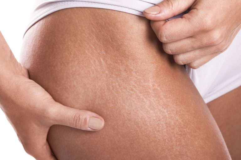 Read more about the article Removal of stretch marks